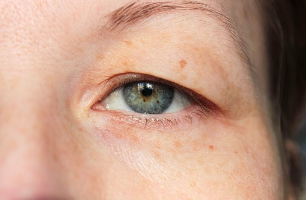 Close-up of a human eye with slightly drooping upper eyelid and visible skin texture around the eye area.
